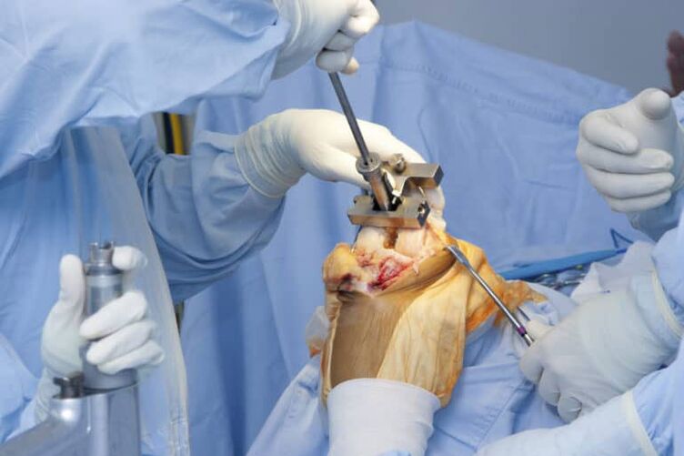 cirugía de artrosis de rodilla