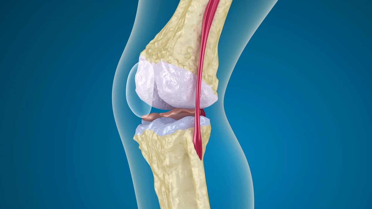 destrucción de la articulación de la rodilla con artrosis