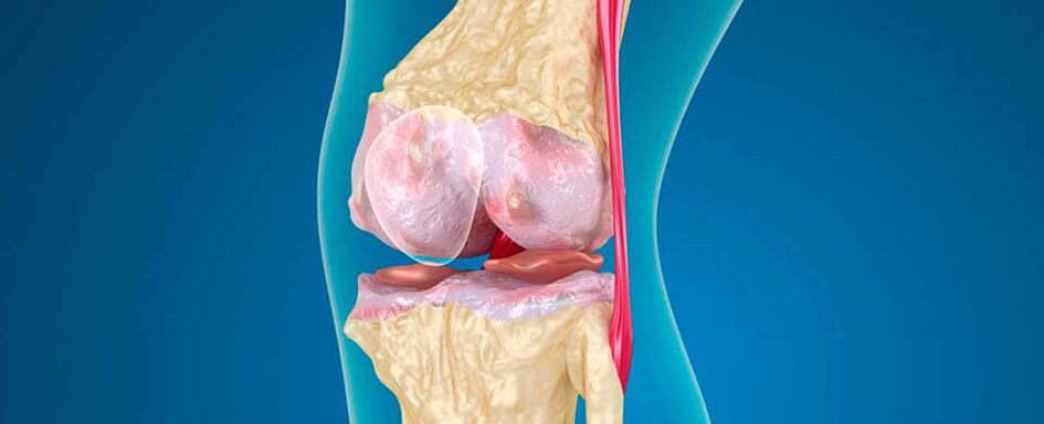 artrosis de rodilla como causa de dolor