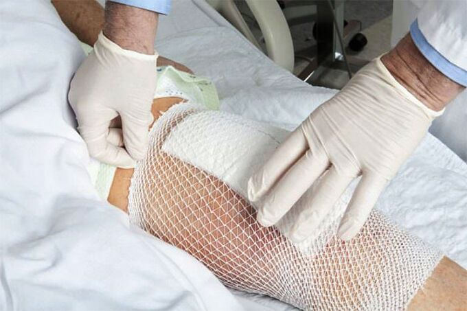 Compresa terapéutica para la artrosis de la articulación de la rodilla