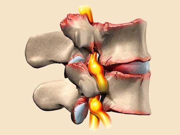 lesión espinal en la osteocondrosis torácica