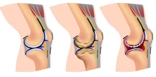 Etapas de deformación de la articulación de la rodilla