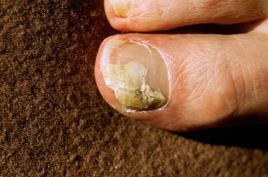 Onicomicosis