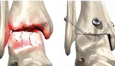 Tratamiento quirúrgico de la artrosis de la rodilla
