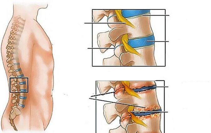 Osteocondrosis de la región lumbar