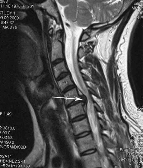 La lesión de la médula espinal causa dolor de cuello