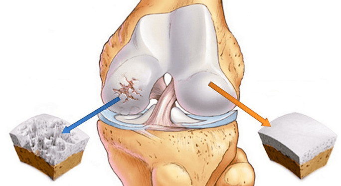 Cartílago sano y cartílago afectado por artrosis.