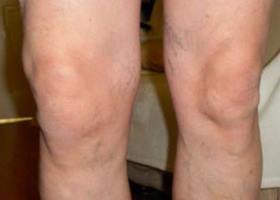 síntomas de rodilla