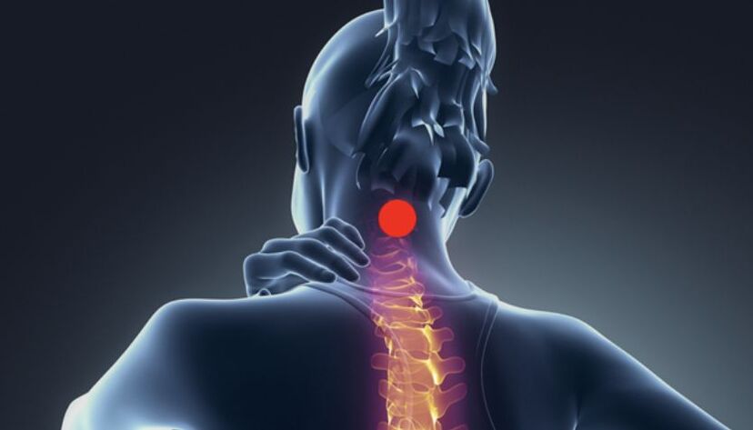 síntomas de osteocondrosis cervical