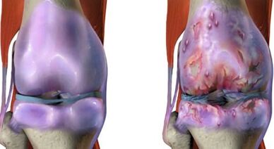 Las principales diferencias de artritis y artrosis