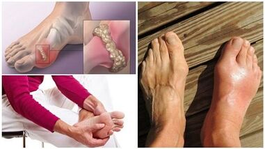 ¿Qué es la artritis de las articulaciones