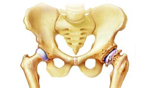 por qué ocurre la artrosis de la articulación de la cadera
